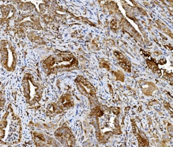 IHC staining of FFPE human gallbladder adenocarcinoma tissue with PDIR antibody. HIER: boil tissue sections in pH8 EDTA for 20 min and allow to cool before testing.