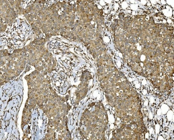 IHC staining of FFPE human breast cancer tissue with PDIR antibody. HIER: boil tissue sections in pH8 EDTA for 20 min and allow to cool before testing.
