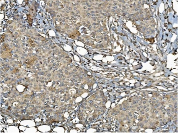 IHC staining of FFPE human breast cancer with ERp5 antibody. HIER: boil tissue sections in pH8 EDTA for 20 min and allow to cool before testing.