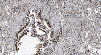 IHC staining of FFPE human lung cancer tissue with SAMHD1 antibody. HIER: boil tissue sections in pH8 EDTA for 20 min and allow to cool before testing.