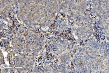 IHC staining of FFPE human lung cancer with PNP antibody. HIER: boil tissue sections in pH8 EDTA for 20 min and allow to cool before testing.