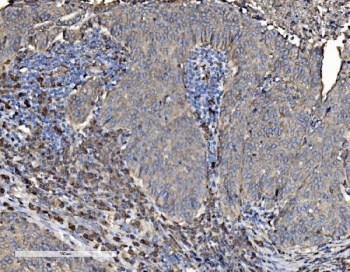 IHC staining of FFPE human lung cancer tissue with PDI antibody. HIER: boil tissue sections in pH8 EDTA for 20 min and allow to cool before testing.