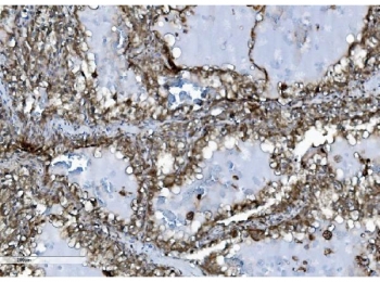 IHC staining of FFPE human renal clear cell carcinoma tissue with INPPL1 antibody. HIER: boil tissue sections in pH8 EDTA for 20 min and allow to cool before testing.
