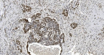 IHC staining of FFPE human ovarian serous adenocarcinoma tissue with CBX5 antibody. HIER: boil tissue sections in pH8 EDTA for 20 min and allow to cool before testing.