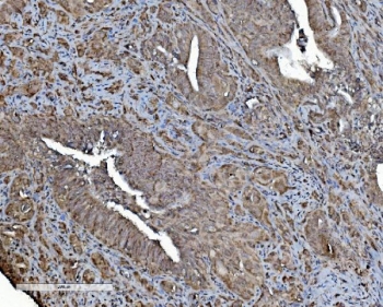 IHC staining of FFPE human gallbladder adenocarcinoma tissue with Prohibitin 2 antibody. HIER: boil tissue sections in pH8 EDTA for 20 min and allow to cool before testing.
