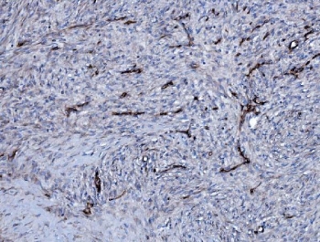 IHC staining of FFPE human ovarian serous adenocarcinoma tissue with EHD3 antibody. HIER: boil tissue sections in pH8 EDTA for 20 min and allow to cool before testing.