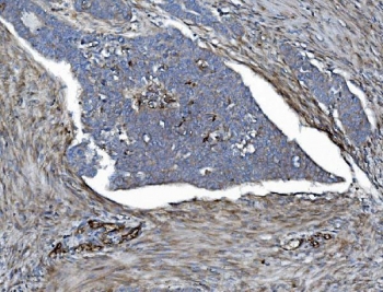 IHC staining of FFPE human ovarian serous adenocarcinoma tissue with EHD3 antibody. HIER: boil tissue sections in pH8 EDTA for 20 min and allow to cool before testing.