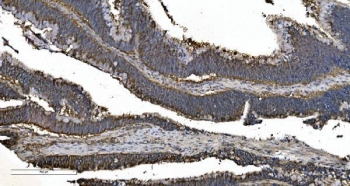 IHC staining of FFPE human rectal cancer with EPRS antibody. HIER: boil tissue sections in pH8 EDTA for 20 min and allow to cool before testing.