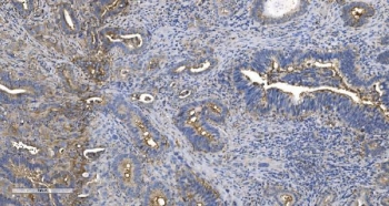 IHC staining of FFPE human gallbladder adenocarcinoma tissue with EPRS antibody. HIER: boil tissue sections in pH8 EDTA for 20 min and allow to cool before testing.