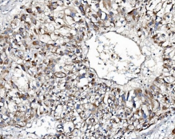 Indoleamine 2,3-Dioxygenase 2 Antibody Liver Cancer IHC. Immunohistochemistry analysis of FFPE human liver carcinoma tissue using Indoleamine 2,3-Dioxygenase 2 Antibody shows cytoplasmic staining in tumor cells with heterogeneous intensity across the tumor field, consistent with IDO2 / INDOL1 localization as a tryptophan metabolism enzyme. The staining is observed within tumor epithelial regions and surrounding microenvironmental cells, supporting involvement in tumor-associated immune regulation. Hematoxylin counterstain provides nuclear contrast and tissue architecture. HIER: boil FFPE tissue sections in pH 8 EDTA for 20 min and allow to cool before testing.