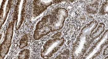 Ku70 Antibody Rectal Cancer IHC. Immunohistochemistry staining of FFPE human rectal cancer tissue with Ku70 antibody. HIER: boil tissue sections in pH8 EDTA for 20 min and allow to cool before testing.