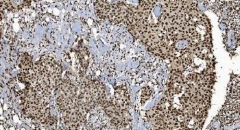 Ku70 Antibody Breast Cancer IHC. Immunohistochemistry staining of FFPE human breast cancer tissue with Ku70 antibody. HIER: boil tissue sections in pH8 EDTA for 20 min and allow to cool before testing.