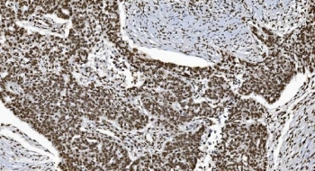 Ku70 Antibody Ovarian Serous Adenocarcinoma IHC. Immunohistochemistry analysis of FFPE human ovarian serous adenocarcinoma tissue stained with Ku70 Antibody demonstrates strong diffuse nuclear HRP-DAB brown staining throughout malignant epithelial tumor cell populations, consistent with XRCC6 / Ku70-associated DNA damage response pathway expression. This DNA end binding protein antibody highlights non-homologous end joining-associated repair signaling and genomic stability regulation within ovarian carcinoma tissue. HIER: boil tissue sections in pH8 EDTA for 20 min and allow to cool before testing.