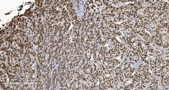 Ku70/XRCC6 Antibody Adrenocortical Adenoma IHC. Immunohistochemistry analysis of FFPE human adrenocortical adenoma tissue stained with Ku70/XRCC6 Antibody demonstrates strong diffuse nuclear HRP-DAB brown staining throughout neoplastic adrenal cortical cell populations, consistent with XRCC6 / Ku70-associated DNA damage response pathway expression. This DNA end binding protein antibody highlights non-homologous end joining-associated repair signaling and genomic stability regulation within adrenal tumor tissue. HIER: boil tissue sections in pH8 EDTA for 20 min and allow to cool before testing.
