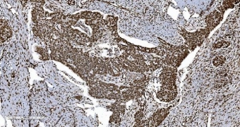 Ku70/XRCC6 Antibody Ovarian Serous Adenocarcinoma IHC. Immunohistochemistry analysis of FFPE human ovarian serous adenocarcinoma tissue stained with Ku70/XRCC6 Antibody demonstrates strong diffuse nuclear HRP-DAB brown staining throughout malignant epithelial tumor cell populations, consistent with XRCC6 / Ku70-associated DNA damage response pathway expression. This DNA end binding protein antibody highlights non-homologous end joining-associated repair signaling and genomic stability regulation within ovarian carcinoma tissue. HIER: boil tissue sections in pH8 EDTA for 20 min and allow to cool before testing.