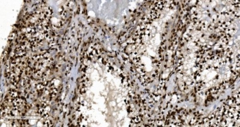 Ku70/XRCC6 Antibody Renal Clear Cell Carcinoma IHC. Immunohistochemistry analysis of FFPE human renal clear cell carcinoma tissue stained with Ku70/XRCC6 Antibody demonstrates strong predominantly nuclear HRP-DAB brown staining throughout malignant renal epithelial tumor cell populations, consistent with XRCC6 / Ku70-associated DNA damage response pathway expression. This DNA end binding protein antibody highlights non-homologous end joining-associated repair signaling and genomic stability regulation within renal carcinoma tissue. HIER: boil tissue sections in pH8 EDTA for 20 min and allow to cool before testing.