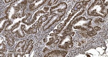 Ku70/XRCC6 Antibody Rectal Cancer IHC. Immunohistochemistry analysis of FFPE human rectal cancer tissue stained with Ku70/XRCC6 Antibody demonstrates strong predominantly nuclear HRP-DAB brown staining throughout gland-forming malignant epithelial tumor cell populations, consistent with XRCC6 / Ku70-associated DNA damage response pathway expression. This DNA end binding protein antibody highlights non-homologous end joining-associated repair signaling and genomic stability regulation within colorectal carcinoma tissue. HIER: boil tissue sections in pH8 EDTA for 20 min and allow to cool before testing.