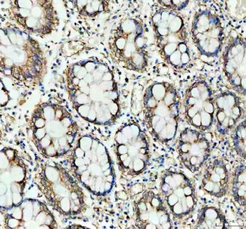 IHC staining of FFPE human colon cancer with PHB antibody. HIER: boil tissue sections in pH8 EDTA for 20 min and allow to cool before testing.
