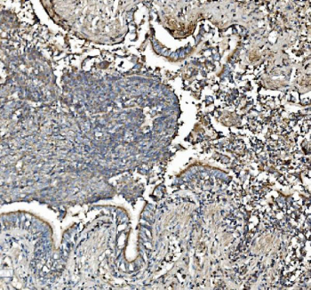 IHC staining of FFPE human lung cancer with PHB antibody. HIER: boil tissue sections in pH8 EDTA for 20 min and allow to cool before testing.