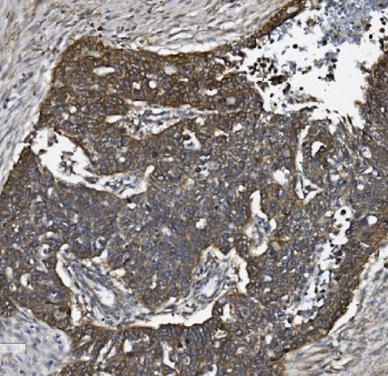 IHC staining of FFPE human ovarian serous adenocarcinoma tissue with ACVRL1 antibody. HIER: boil tissue sections in pH8 EDTA for 20 min and allow to cool before testing.
