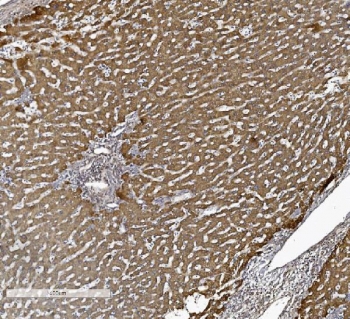 IHC staining of FFPE human liver cancer tissue with ACVRL1 antibody. HIER: boil tissue sections in pH8 EDTA for 20 min and allow to cool before testing.