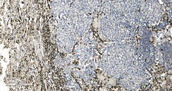 IHC staining of FFPE human lung cancer tissue with Coronin 1a antibody. HIER: boil tissue sections in pH8 EDTA for 20 min and allow to cool before testing.