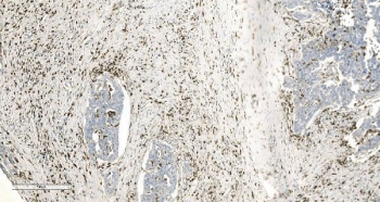 IHC staining of FFPE human ovarian serous adenocarcinoma tissue with Coronin 1a antibody. HIER: boil tissue sections in pH8 EDTA for 20 min and allow to cool before testing.