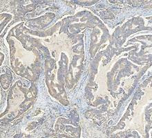 IHC staining of FFPE human colon cancer tissue with Glutamic-oxaloacetic transaminase 1 antibody, HRP-secondary and DAB substrate. HIER: boil tissue sections in pH8 EDTA for 20 min and allow to cool before testing.