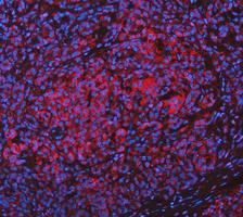Immunofluorescent staining of FFPE human pancreas cancer tissue with Glutamic-oxaloacetic transaminase 1 antibody (red) and DAPI nuclear stain (blue). HIER: steam section in pH8 EDTA buffer for 20 min.