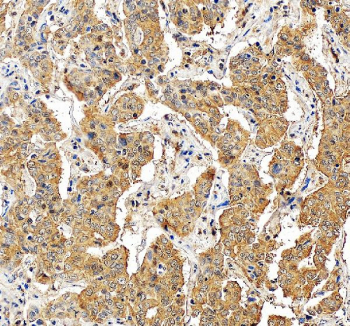 IHC staining of FFPE human liver cancer tissue with Glutamic-oxaloacetic transaminase 1 antibody, HRP-secondary and DAB substrate. HIER: boil tissue sections in pH8 EDTA for 20 min and allow to cool before testing.