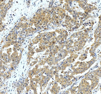 IHC staining of FFPE human liver cancer tissue with Glutamic-oxaloacetic transaminase 1 antibody, HRP-secondary and DAB substrate. HIER: boil tissue sections in pH8 EDTA for 20 min and allow to cool before testing.
