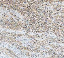 IHC staining of FFPE human bladder cancer tissue with Glutamic-oxaloacetic transaminase 1 antibody, HRP-secondary and DAB substrate. HIER: boil tissue sections in pH8 EDTA for 20 min and allow to cool before testing.