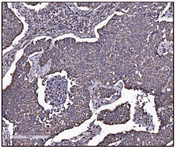 IHC staining of FFPE human lung cancer tissue with Glutamate-oxaloacetate transaminase 2 antibody. HIER: boil tissue sections in pH8 EDTA for 20 min and allow to cool before testing.