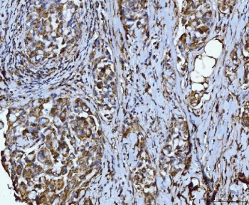 IHC staining of FFPE human breast cancer tissue with Integrin linked protein kinase antibody. HIER: boil tissue sections in pH8 EDTA for 20 min and allow to cool before testing.