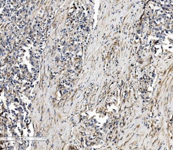 IHC staining of FFPE human gastric cancer tissue with SEC14L3 antibody. HIER: boil tissue sections in pH8 EDTA for 20 min and allow to cool before testing.