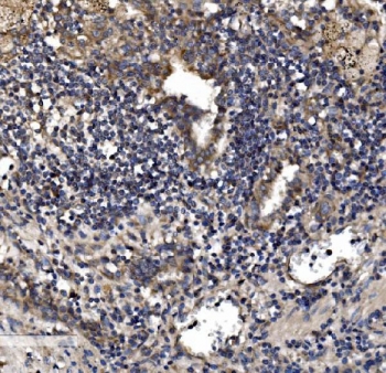IHC staining of FFPE human lung cancer tissue with Astrin antibody. HIER: boil tissue sections in pH8 EDTA for 20 min and allow to cool before testing.