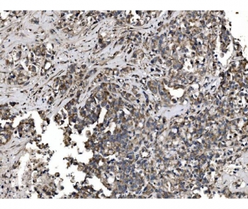 IHC staining of FFPE human gastric cancer tissue with Astrin antibody. HIER: boil tissue sections in pH8 EDTA for 20 min and allow to cool before testing.
