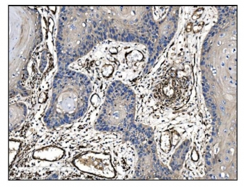 IHC staining of FFPE human esophageal squamous carcinoma tissue with TAGLN antibody. HIER: boil tissue sections in pH8 EDTA for 20 min and allow to cool before testing.