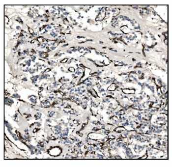 IHC staining of FFPE human adrenal cortical adenocarcinoma tissue with TAGLN antibody. HIER: boil tissue sections in pH8 EDTA for 20 min and allow to cool before testing.