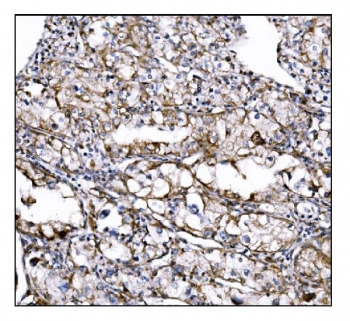 IHC staining of FFPE human renal clear cell carcinoma tissue with DLGAP1 antibody. HIER: boil tissue sections in pH8 EDTA for 20 min and allow to cool before testing.