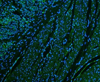 Immunofluorescence analysis of CD39 Antibody in FFPE human colon cancer tissue. The rabbit polyclonal antibody demonstrates green cytoplasmic and membranous staining in malignant epithelial cells, consistent with ENTPD1 / CD39 expression, while DAPI (blue) highlights cell nuclei. Heat-induced epitope retrieval was performed by steaming sections in pH 6 citrate buffer for 20 minutes prior to staining.