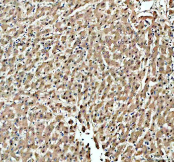 IHC staining of FFPE human liver cancer tissue with Histone acetyltransferase 1 antibody, HRP-secondary and DAB substrate. HIER: boil tissue sections in pH8 EDTA for 20 min and allow to cool before testing.