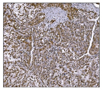 IHC staining of FFPE human liver cancer tissue with LRP1B antibody. HIER: boil tissue sections in pH8 EDTA for 20 min and allow to cool before testing.