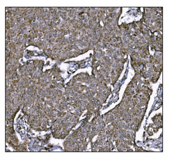 IHC staining of FFPE human breast cancer tissue with LRP1B antibody. HIER: boil tissue sections in pH8 EDTA for 20 min and allow to cool before testing.
