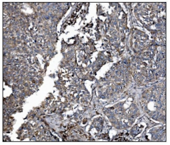 IHC staining of FFPE human lung cancer tissue with LRP1B antibody. HIER: boil tissue sections in pH8 EDTA for 20 min and allow to cool before testing.