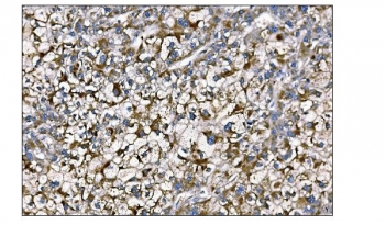 IHC staining of FFPE human liver cancer tissue with MerTK antibody. HIER: boil tissue sections in pH8 EDTA for 20 min and allow to cool before testing.