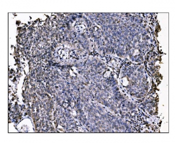 IHC staining of FFPE human lung cancer tissue with NDE1 antibody. HIER: boil tissue sections in pH8 EDTA for 20 min and allow to cool before testing.