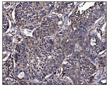 IHC staining of FFPE human lung cancer tissue with POGLUT1 antibody. HIER: boil tissue sections in pH8 EDTA for 20 min and allow to cool before testing.