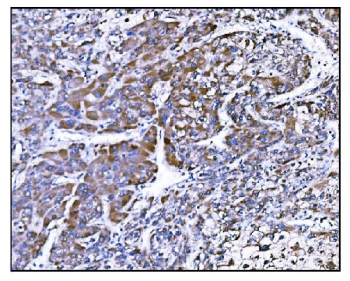IHC staining of FFPE human liver cancer tissue with Prolyl Endopeptidase antibody. HIER: boil tissue sections in pH8 EDTA for 20 min and allow to cool before testing.