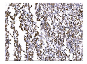 IHC staining of FFPE human pancreatic cancer tissue with Prolyl Endopeptidase antibody. HIER: boil tissue sections in pH8 EDTA for 20 min and allow to cool before testing.
